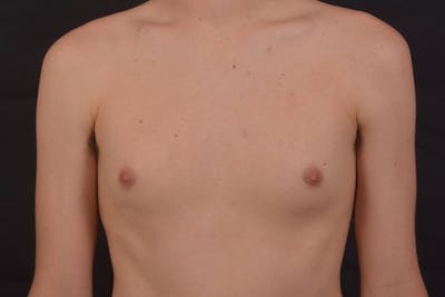 Gynecomastia Before & After Gallery - Patient 133627 - Image 1