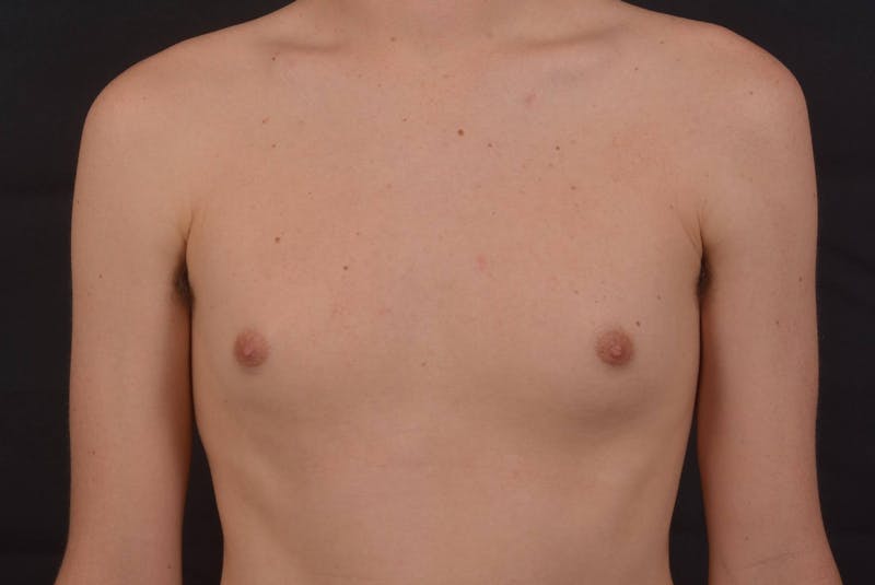Gynecomastia Before & After Gallery - Patient 133627 - Image 1
