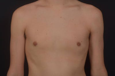 Gynecomastia Before & After Gallery - Patient 133627 - Image 2