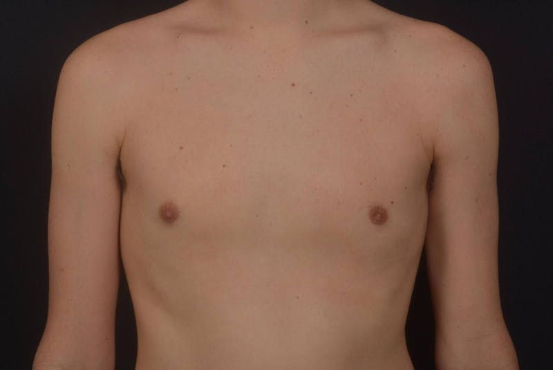 Gynecomastia Before & After Gallery - Patient 133627 - Image 2
