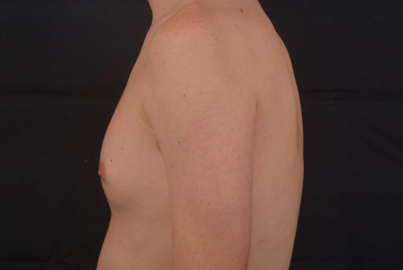 Gynecomastia Before & After Gallery - Patient 133627 - Image 3