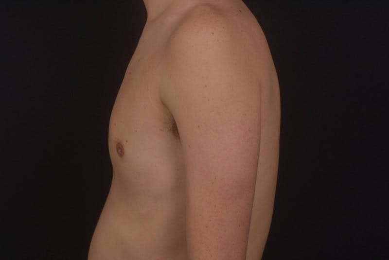 Gynecomastia Before & After Gallery - Patient 133627 - Image 4