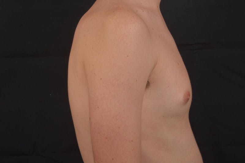 Gynecomastia Before & After Gallery - Patient 133627 - Image 5