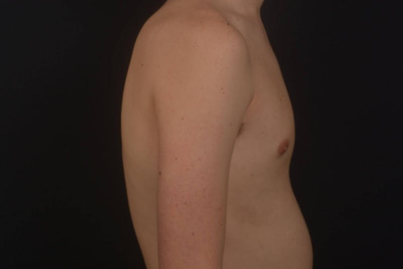 Gynecomastia Before & After Gallery - Patient 133627 - Image 6