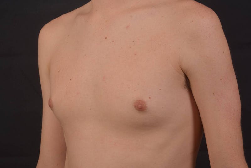 Gynecomastia Before & After Gallery - Patient 133627 - Image 7