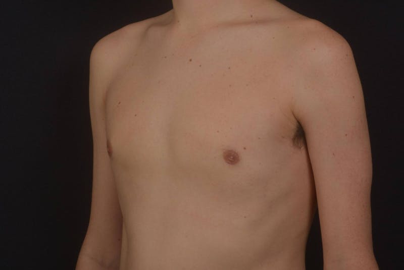 Gynecomastia Before & After Gallery - Patient 133627 - Image 8