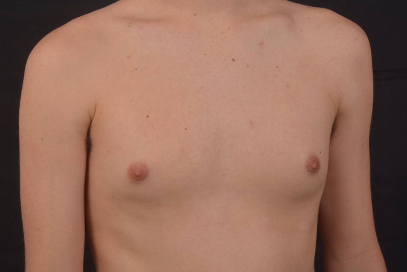 Gynecomastia Before & After Gallery - Patient 133627 - Image 9