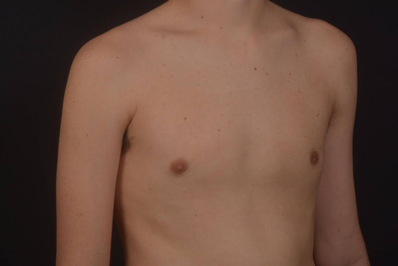 Gynecomastia Before & After Gallery - Patient 133627 - Image 10
