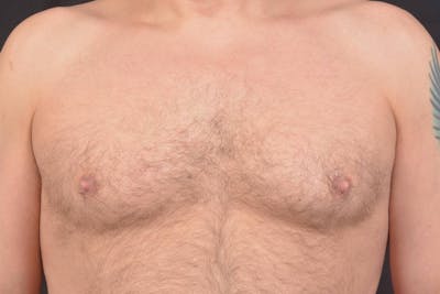 Gynecomastia Before & After Gallery - Patient 771448 - Image 1