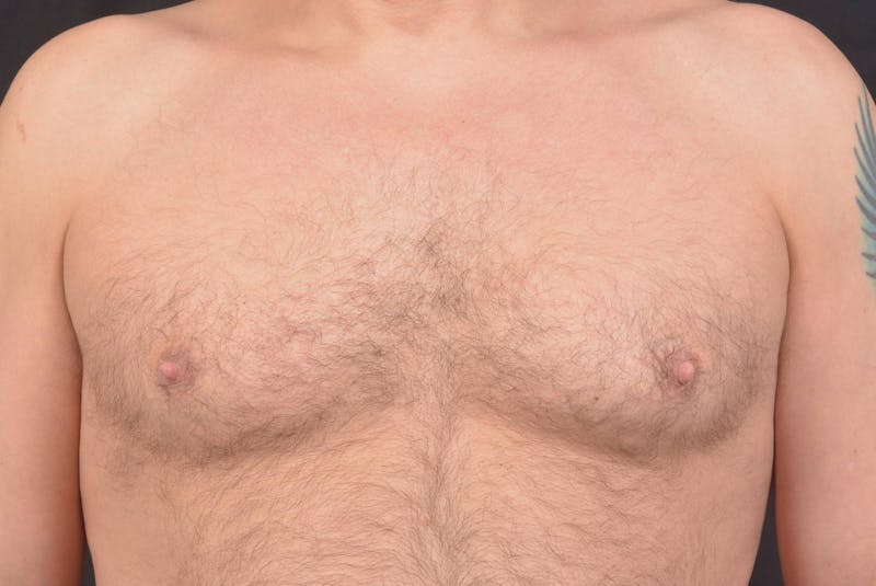 Gynecomastia Before & After Gallery - Patient 771448 - Image 1