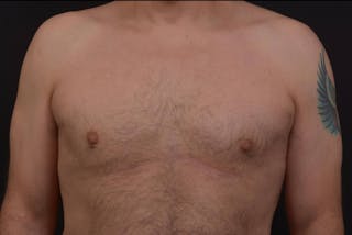 Gynecomastia Before & After Gallery - Patient 771448 - Image 2