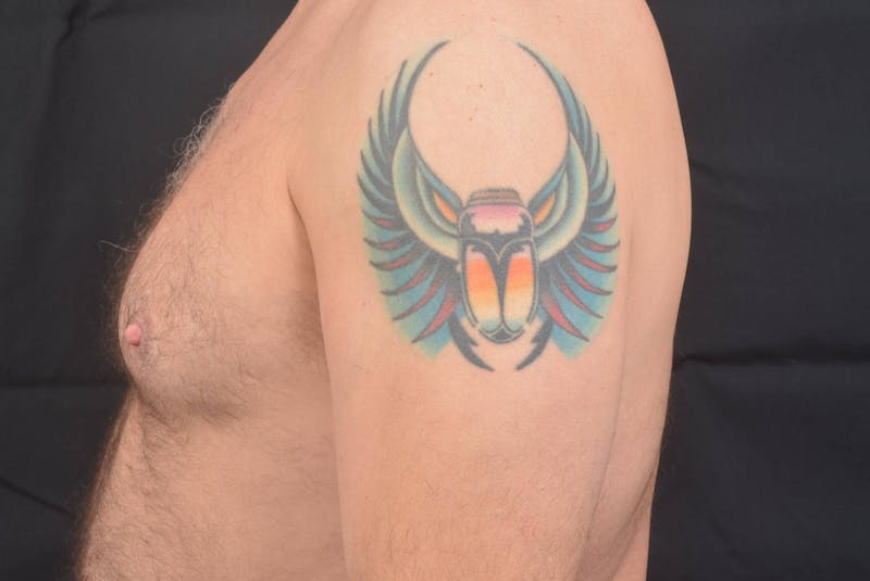 Gynecomastia Before & After Gallery - Patient 771448 - Image 3