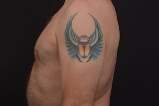 Gynecomastia Before & After Gallery - Patient 771448 - Image 4