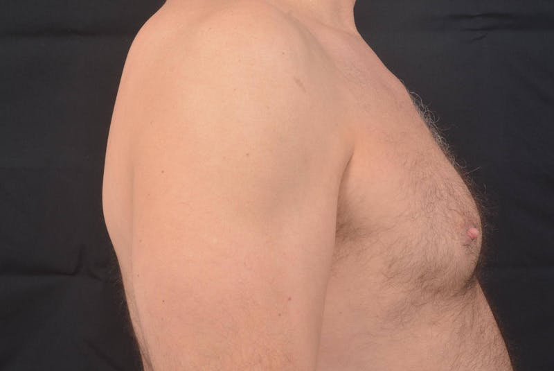 Gynecomastia Before & After Gallery - Patient 771448 - Image 5