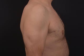 Gynecomastia Before & After Gallery - Patient 771448 - Image 6