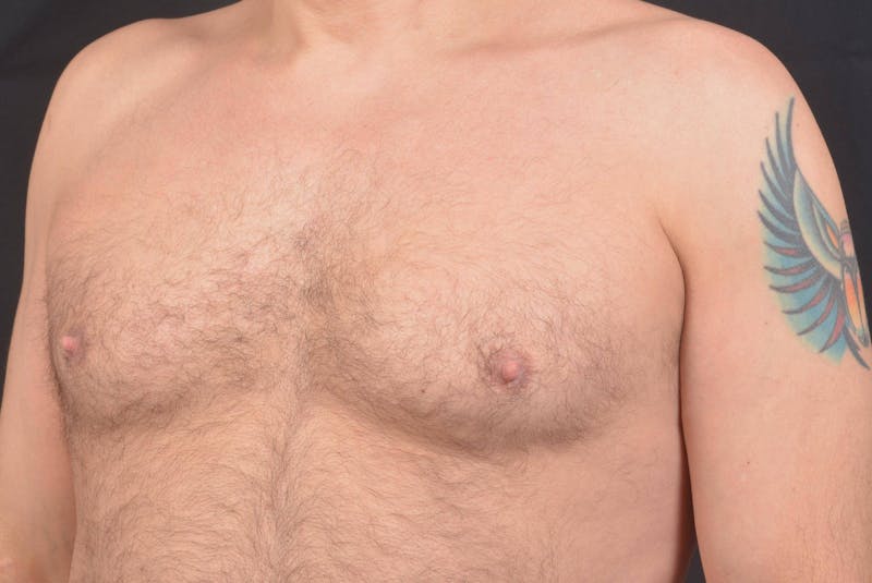 Gynecomastia Before & After Gallery - Patient 771448 - Image 7