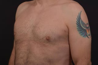 Gynecomastia Before & After Gallery - Patient 771448 - Image 8