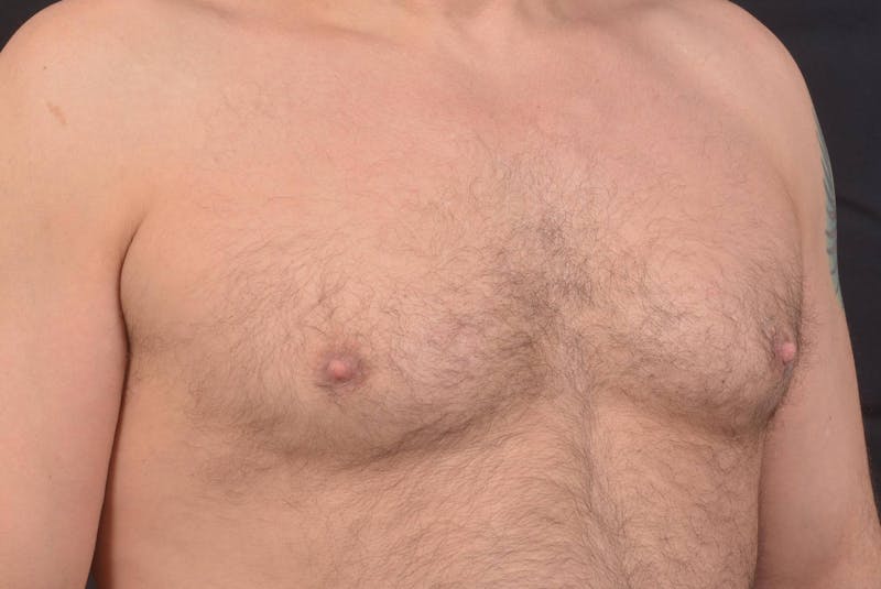 Gynecomastia Before & After Gallery - Patient 771448 - Image 9