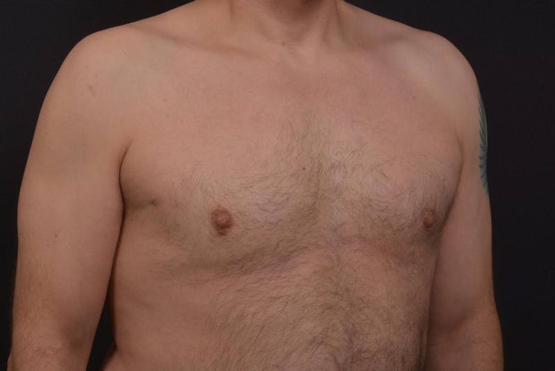 Gynecomastia Before & After Gallery - Patient 771448 - Image 10