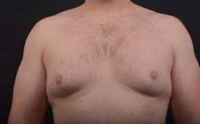 Gynecomastia Before & After Gallery - Patient 153510 - Image 1