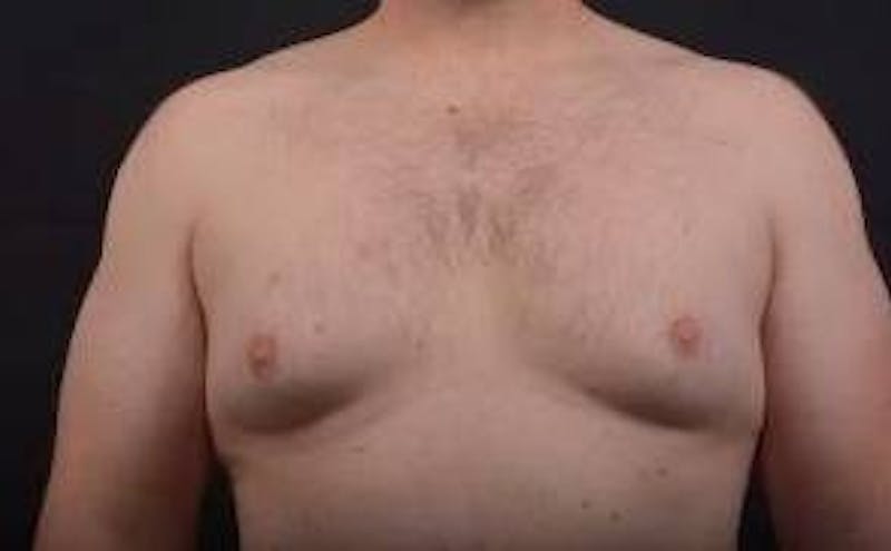 Gynecomastia Before & After Gallery - Patient 153510 - Image 1