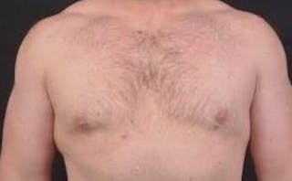 Gynecomastia Before & After Gallery - Patient 153510 - Image 2