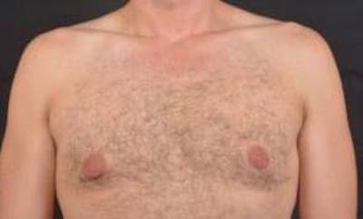 Gynecomastia Before & After Gallery - Patient 148368 - Image 1