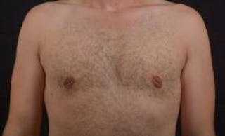 Gynecomastia Before & After Gallery - Patient 148368 - Image 2