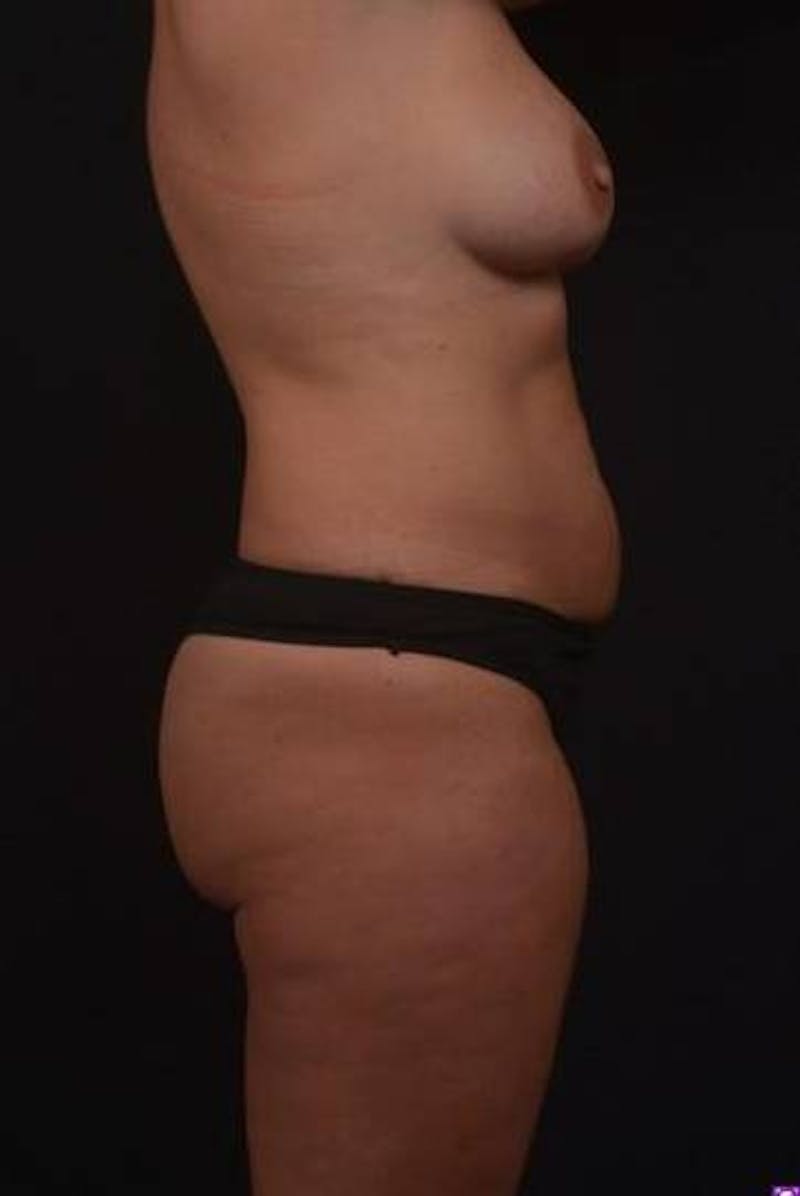 360 Liposuction Before & After Gallery - Patient 351706 - Image 9