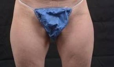 360 Liposuction Before & After Gallery - Patient 387019 - Image 1