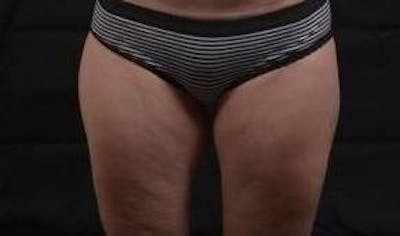360 Liposuction Before & After Gallery - Patient 387019 - Image 2