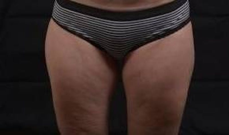 360 Liposuction Before & After Gallery - Patient 387019 - Image 2
