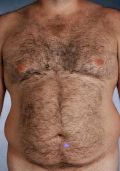 360 Liposuction Before & After Gallery - Patient 422662 - Image 1