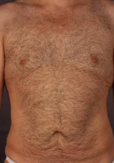 360 Liposuction Before & After Gallery - Patient 422662 - Image 2