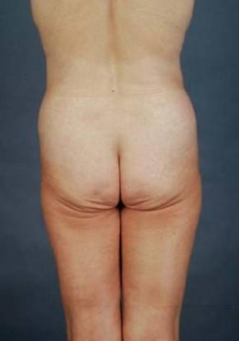 360 Liposuction Before & After Gallery - Patient 172946 - Image 1