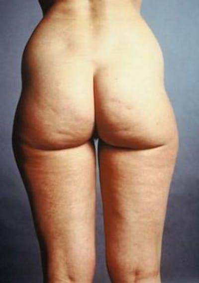 360 Liposuction Before & After Gallery - Patient 234006 - Image 1