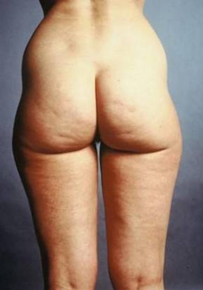 360 Liposuction Before & After Gallery - Patient 234006 - Image 1