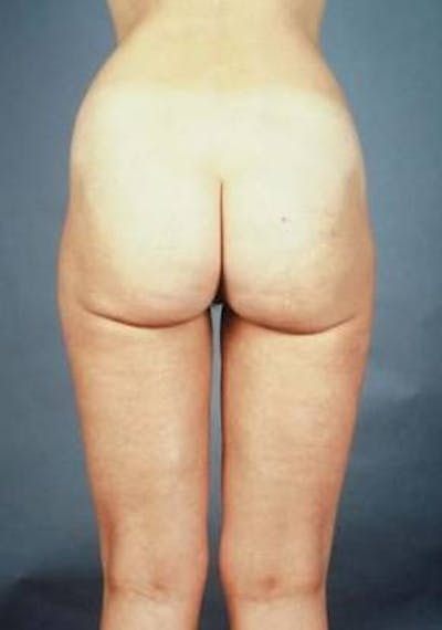 360 Liposuction Before & After Gallery - Patient 234006 - Image 2