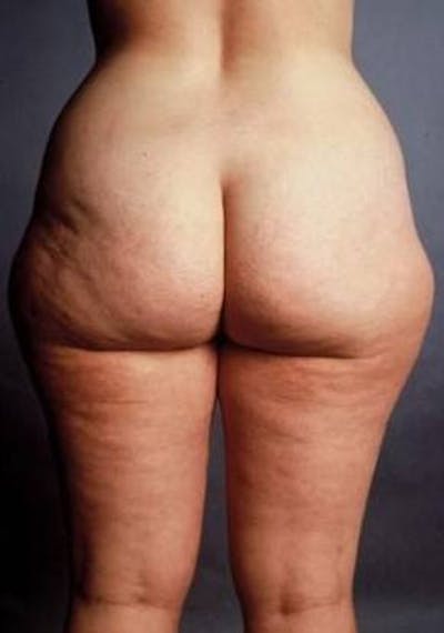 360 Liposuction Before & After Gallery - Patient 159996 - Image 1