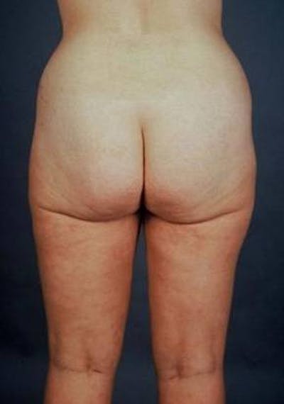 360 Liposuction Before & After Gallery - Patient 159996 - Image 2