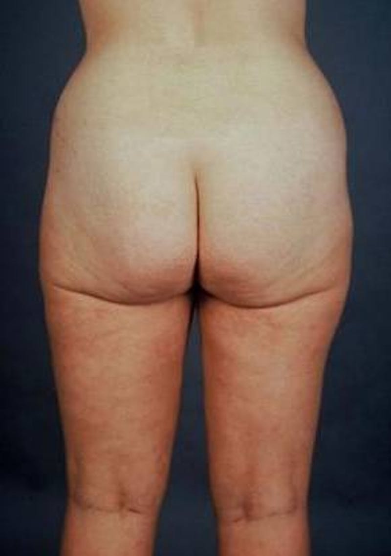 360 Liposuction Before & After Gallery - Patient 159996 - Image 2