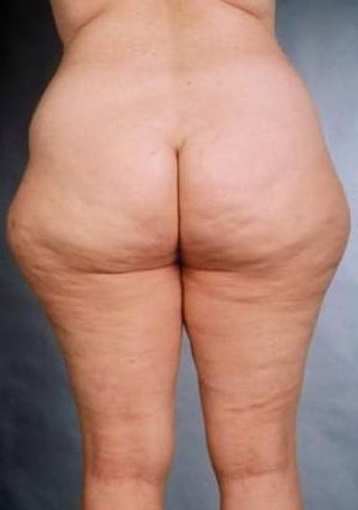 360 Liposuction Before & After Gallery - Patient 137776 - Image 1
