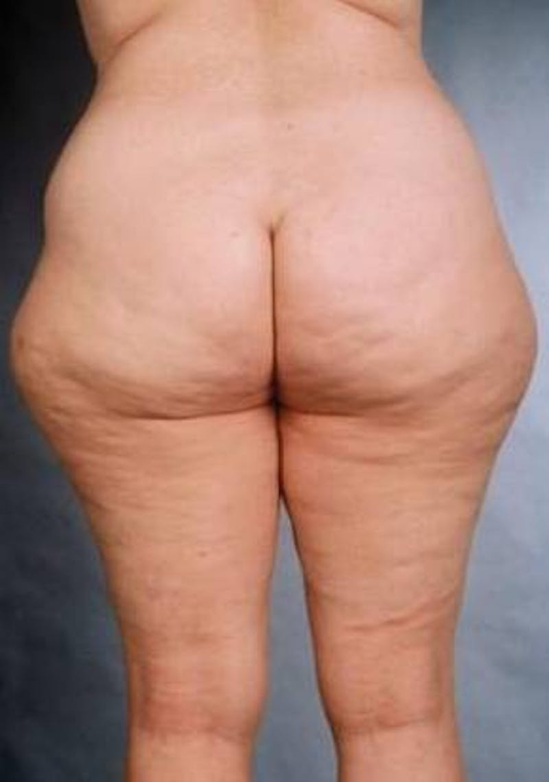 360 Liposuction Before & After Gallery - Patient 137776 - Image 1