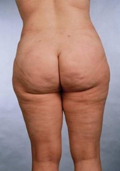 360 Liposuction Before & After Gallery - Patient 137776 - Image 2