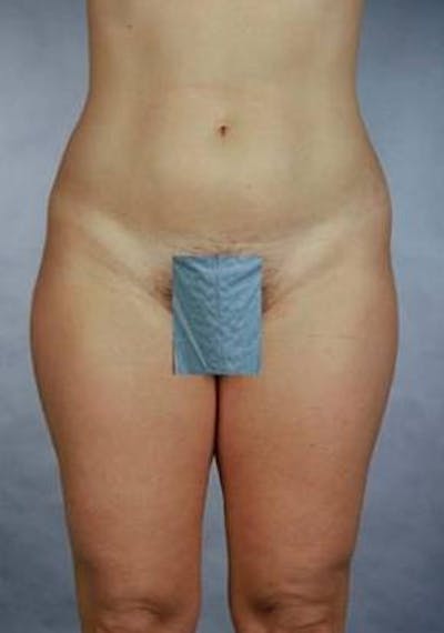 360 Liposuction Before & After Gallery - Patient 407503 - Image 1
