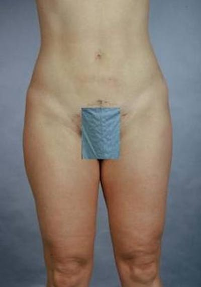 360 Liposuction Before & After Gallery - Patient 407503 - Image 2