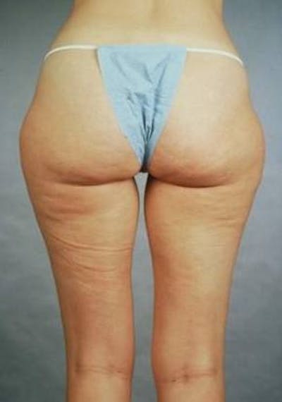 360 Liposuction Before & After Gallery - Patient 337373 - Image 1