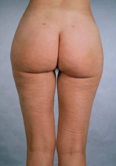 360 Liposuction Before & After Gallery - Patient 337373 - Image 2