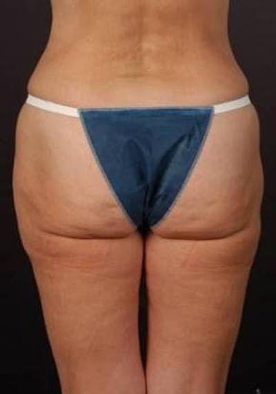 360 Liposuction Before & After Gallery - Patient 390313 - Image 1