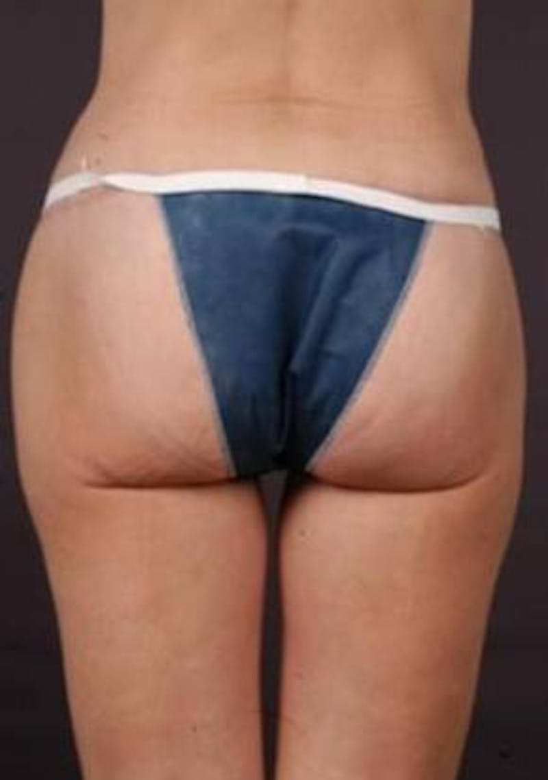 360 Liposuction Before & After Gallery - Patient 390313 - Image 2
